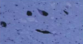 PD���ߺ�����Ԫɥʧ