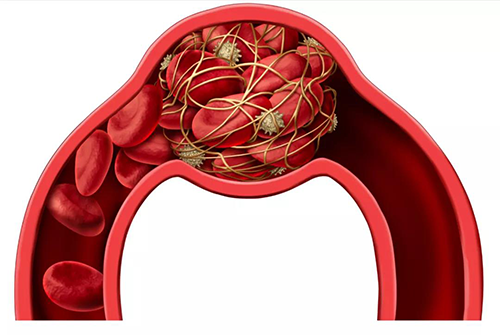 ���з���һ�����Բ�ȱѪ����Ѫ������֢״Ϊ��Ҫ�ٴ����ֵļ���