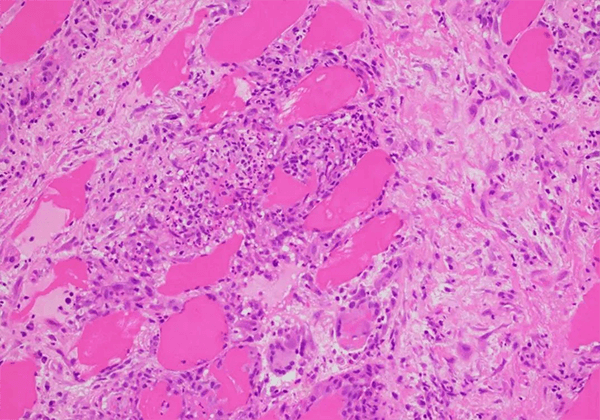 ������÷���������ƽ�ڲ���KBMAB-16��FDA��׼�ٴ�